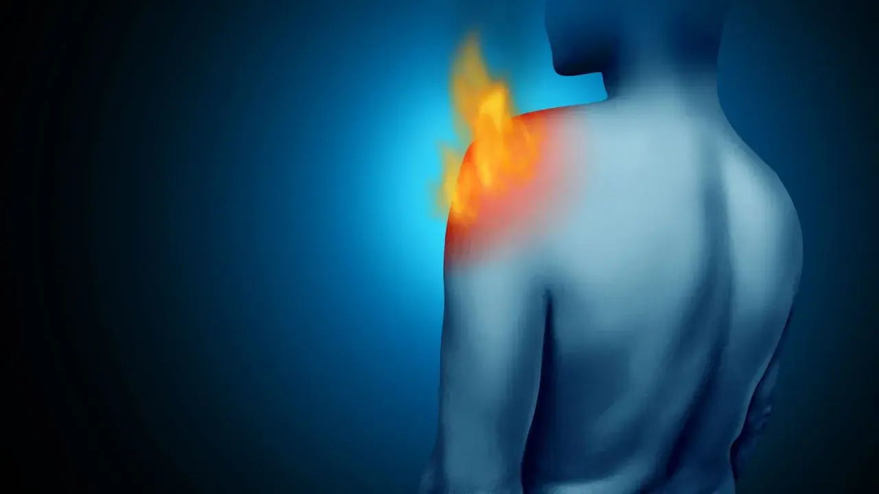 Schulteransicht mit Flammen, die den entzündeten Schleimbeutel in der Schulter symbolisieren.