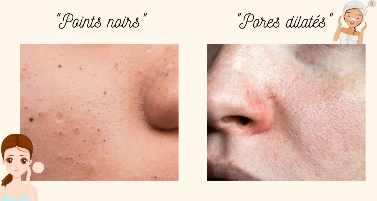 Comparaison de peau : points noirs et pores dilatés. Découvrez comment resserrer les pores pour une peau plus lisse.
