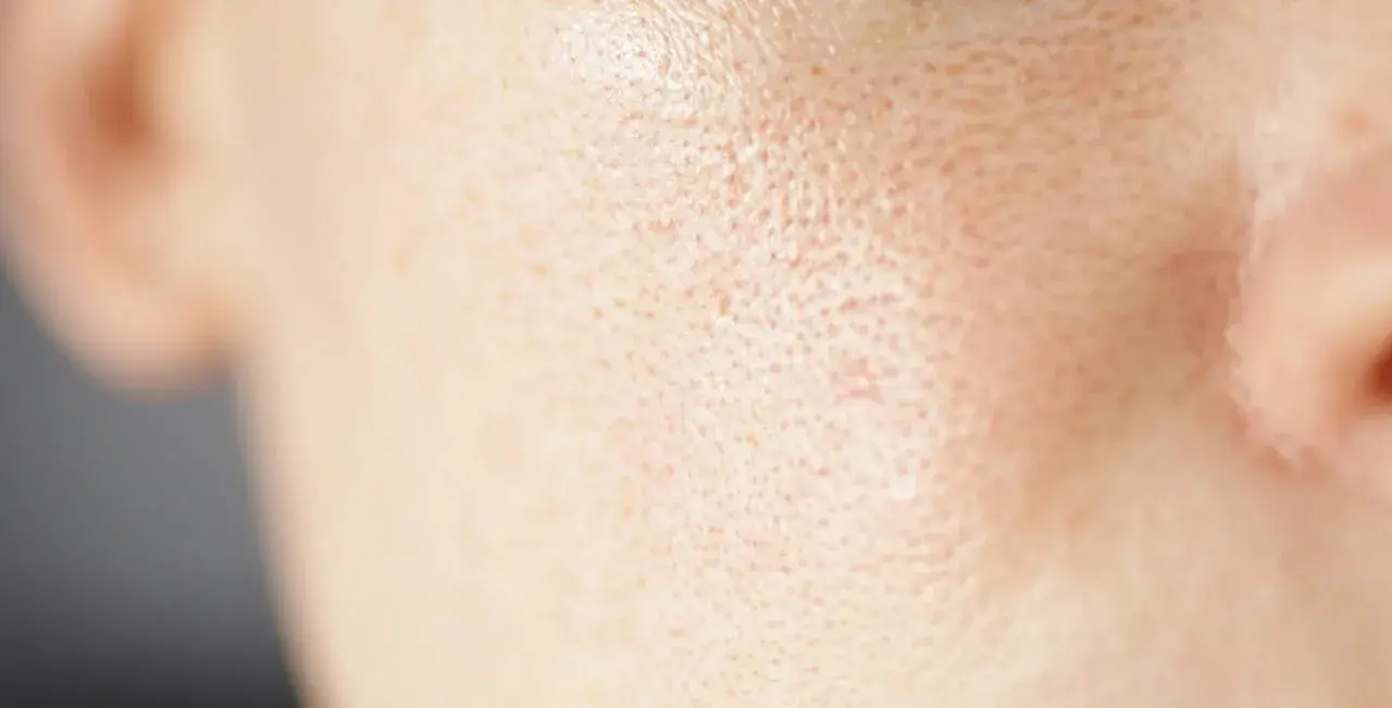 Primo piano della pelle del viso con pori dilatati sulle guance, evidenziando la texture.
