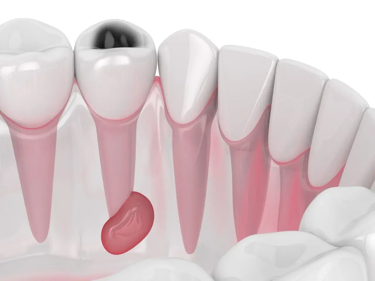Dente cariato con ascesso gengivale. Si cercano rimedi della nonna, ma la situazione richiede attenzione medica.