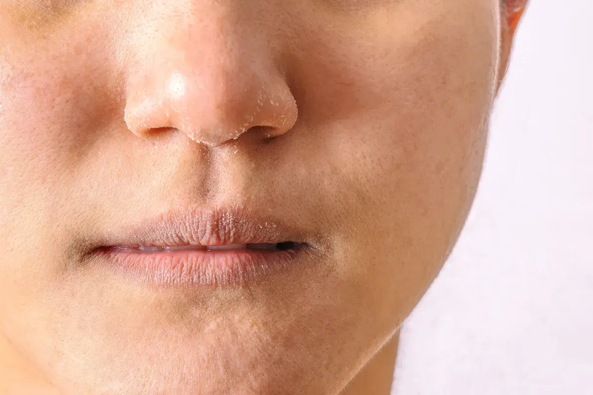 Nahaufnahme eines Gesichts mit trockener, schuppiger Haut um Mund und Nase, was auf periorale Dermatitis am Kinn hindeuten könnte.