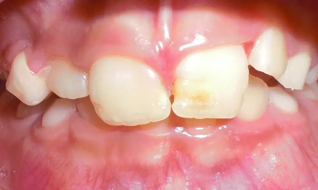 Dientes infantiles con caries incipiente. El flúor ayuda a fortalecer el esmalte y previene futuras caries.