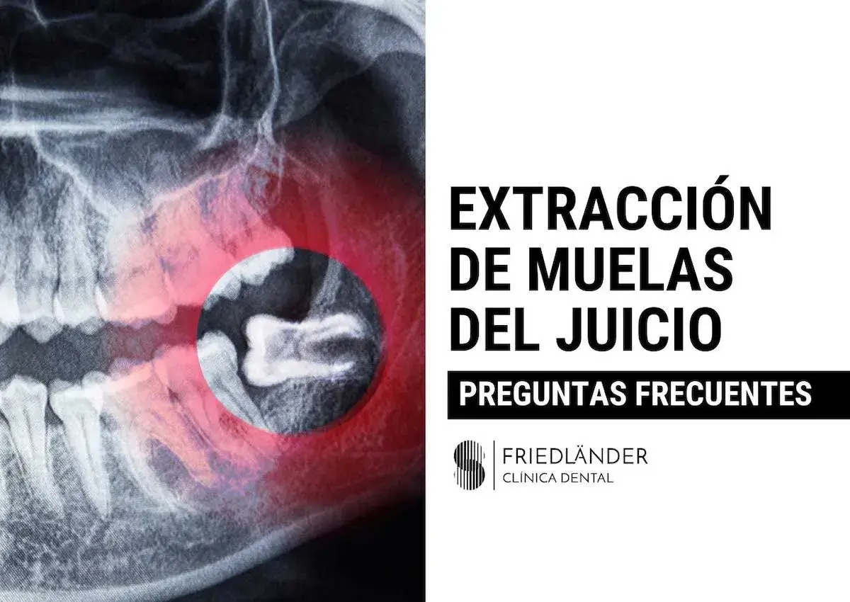 Radiografía dental muestra la extracción de muelas del juicio. Texto: "Extracción de Muelas del Juicio. Preguntas Frecuentes.