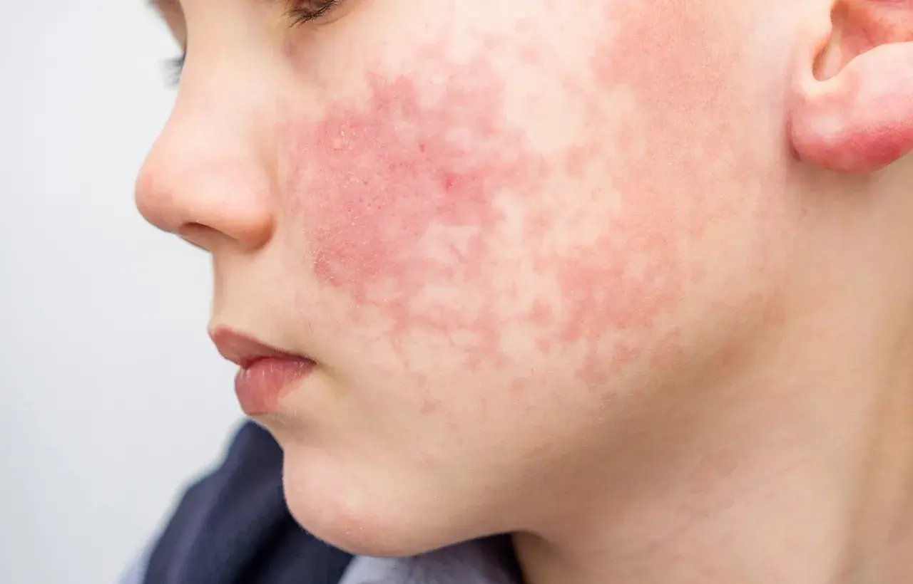 Visage d'enfant marqué par une rougeur diffuse et des plaques, symptômes de dermatite atopique aggravée par la transpiration.