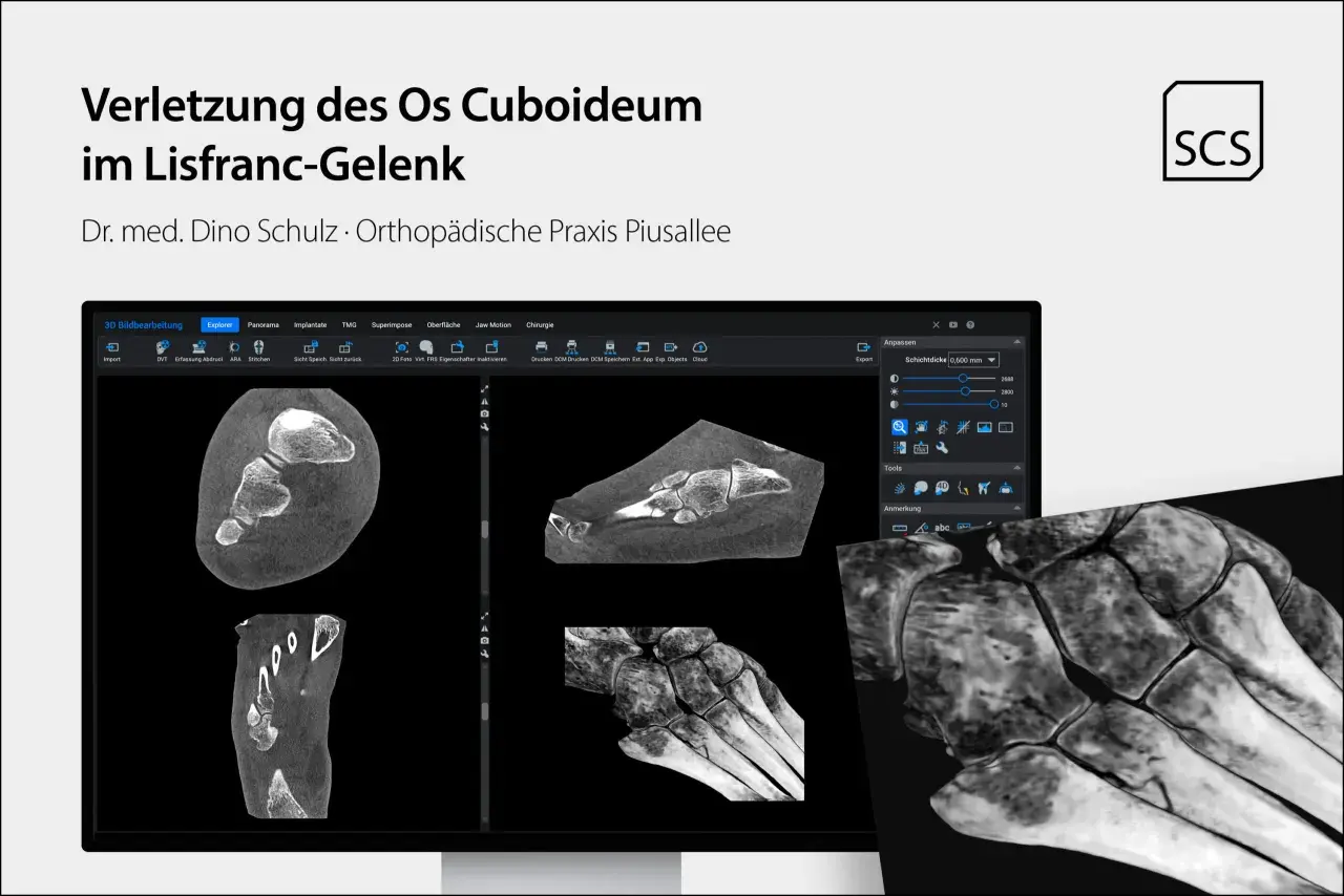 CT-Aufnahmen zeigen eine Verletzung des Os cuboideum im Lisfranc-Gelenk. Die Darstellung ermöglicht eine detaillierte Analyse der Knochenstruktur.