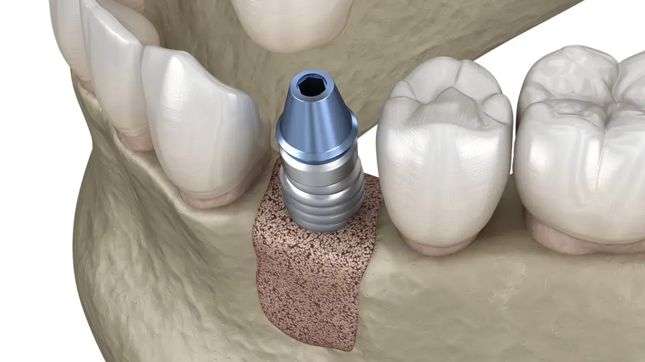 Impianto dentale inserito nell'osso mascellare, pronto per l'integrazione. L'osso autologo offre una base solida per il successo del trattamento.