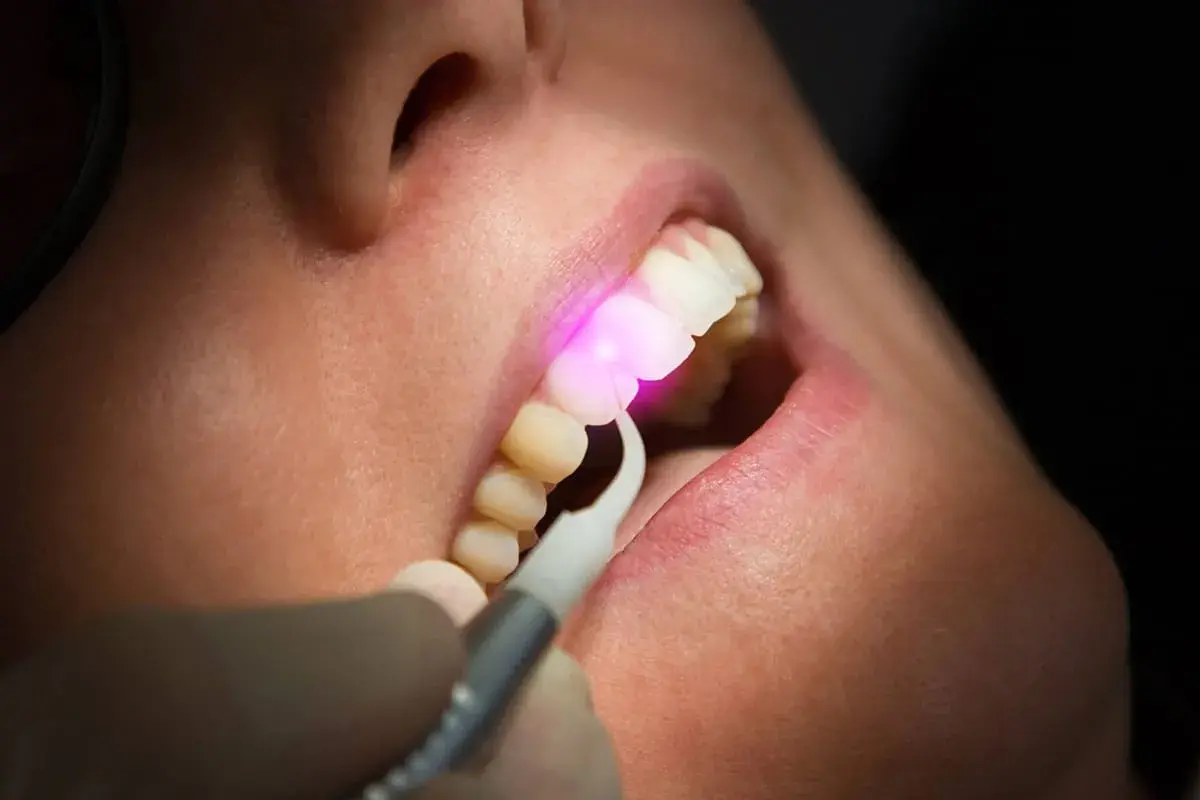 Trattamento gengivale con laser, un raggio rosa illumina i denti e le gengive.