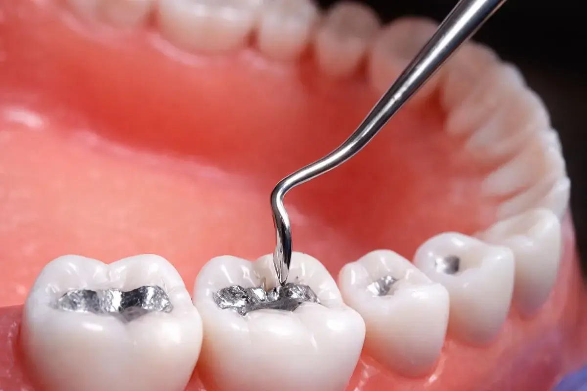 Un dentista aplica una amalgama dental a una muela.