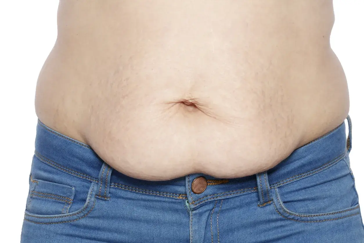 En mage med slapp hud efter viktnedgång, med synliga bristningar och en navel. Bär blå jeans.
