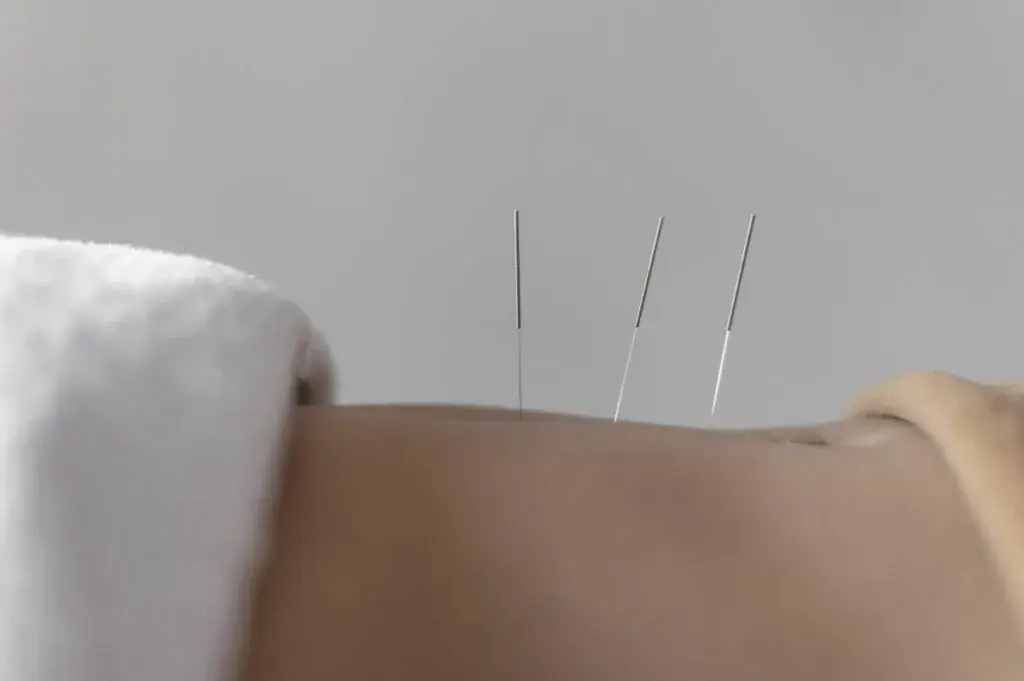 Akupunktura kręgosłupa lędźwiowego: ulga w bólu?