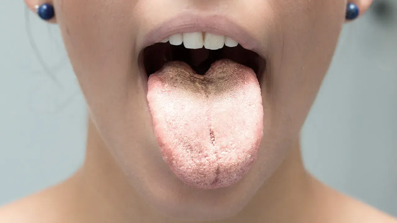 Lingua con patina biancastra e ruvida, possibile sintomo di candida orale cause.