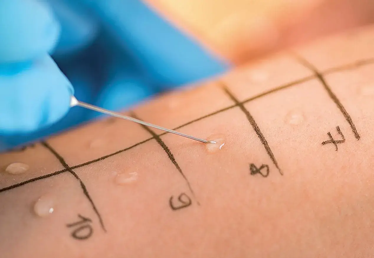 Allergietest auf der Haut: Eine Nadel mit einer Flüssigkeit wird auf markierte Felder aufgetragen, um eine mögliche eibisch allergie zu identifizieren.