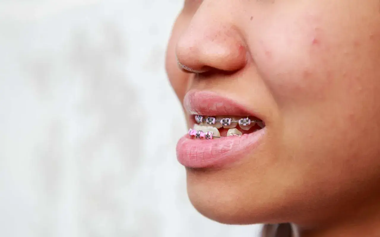 Primo piano di un sorriso con apparecchio ortodontico, inclusi brackets rosa, per correggere un morso inverso.