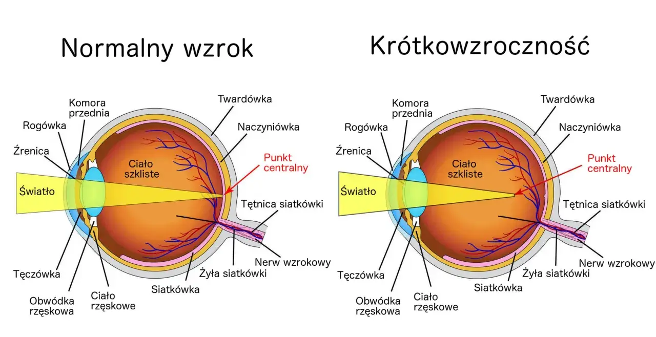 Porównanie budowy oka z krótkowzrocznością i normalnym wzrokiem. Światło skupia się przed siatkówką.