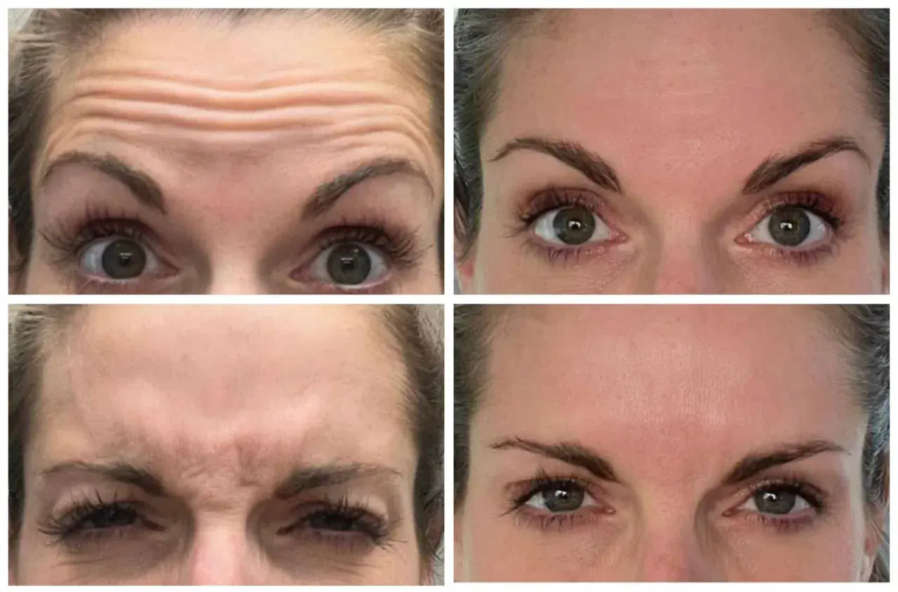 Vier close-ups van een voorhoofd met rimpels, die de effecten van botox tonen. Sommigen beweren dat botox slecht voor hersenen kan zijn.
