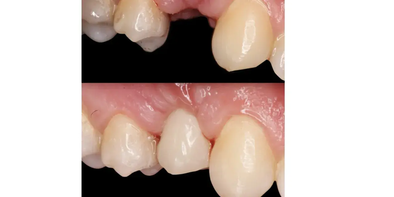 Prima e dopo un ponte dentale Maryland. Si notano i potenziali svantaggi: recessione gengivale e possibile infiltrazione.