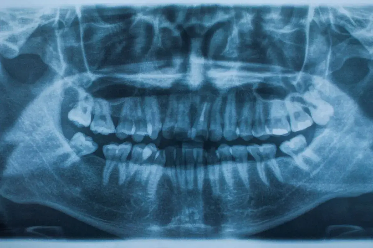 Radiografía panorámica dental que muestra la dentadura completa. Se aprecian signos de posible traumatismo dental, como dientes fracturados o desplazados.