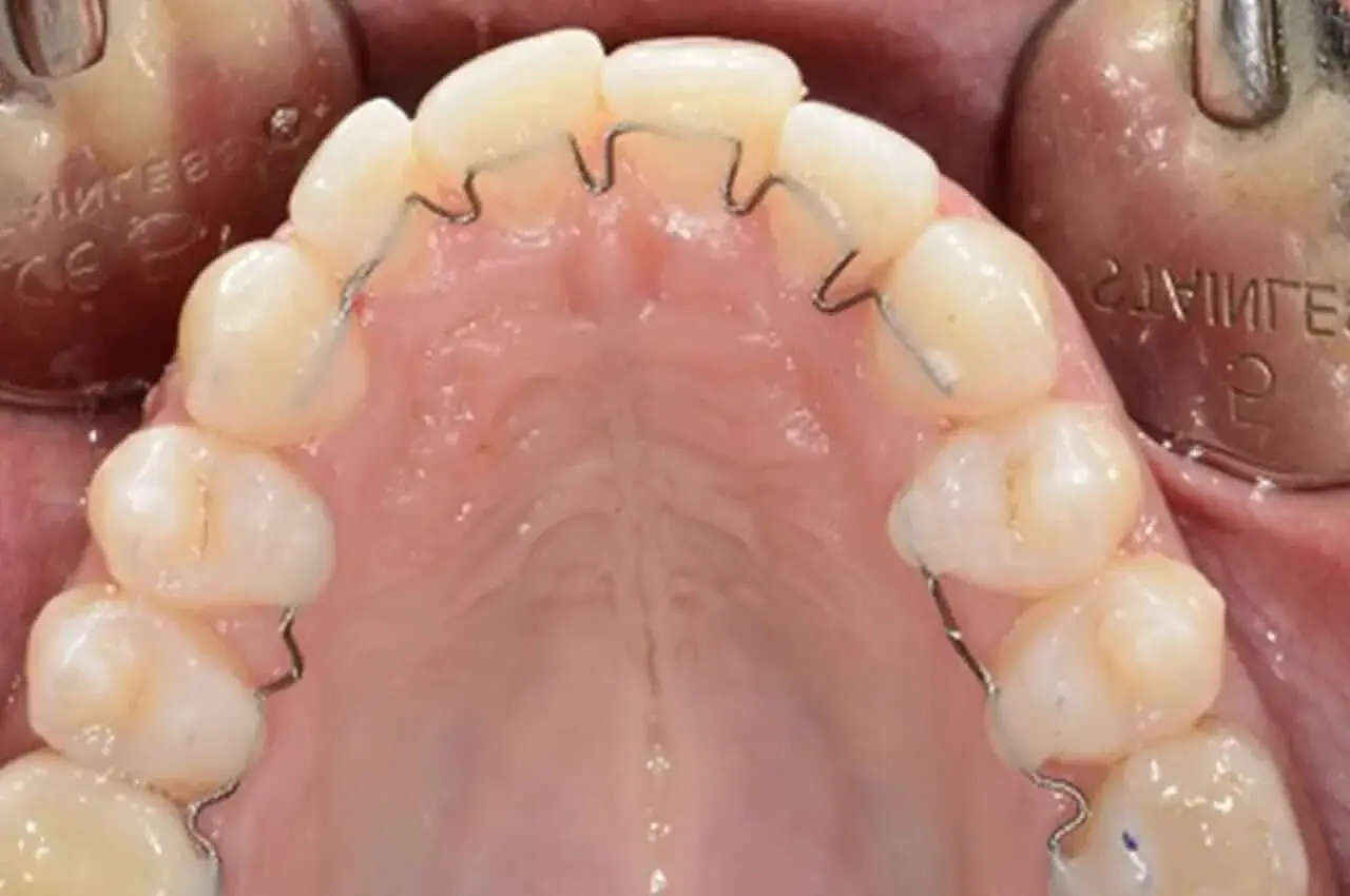 Dente cariato con apparecchio ortodontico. La carie è visibile su un dente, mentre gli altri sono allineati da un filo metallico.