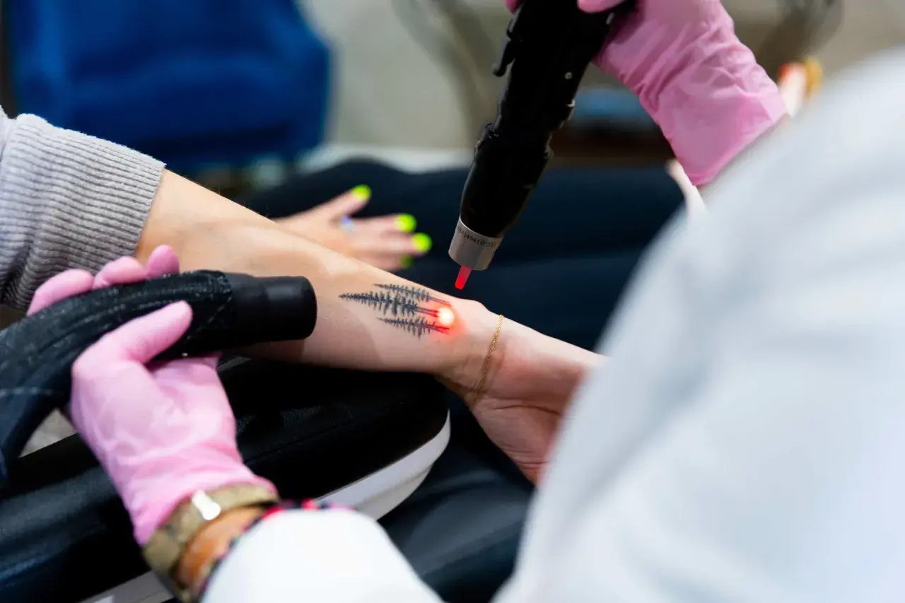 En person får bort en gammal lasra tatuering med en laserbehandling.