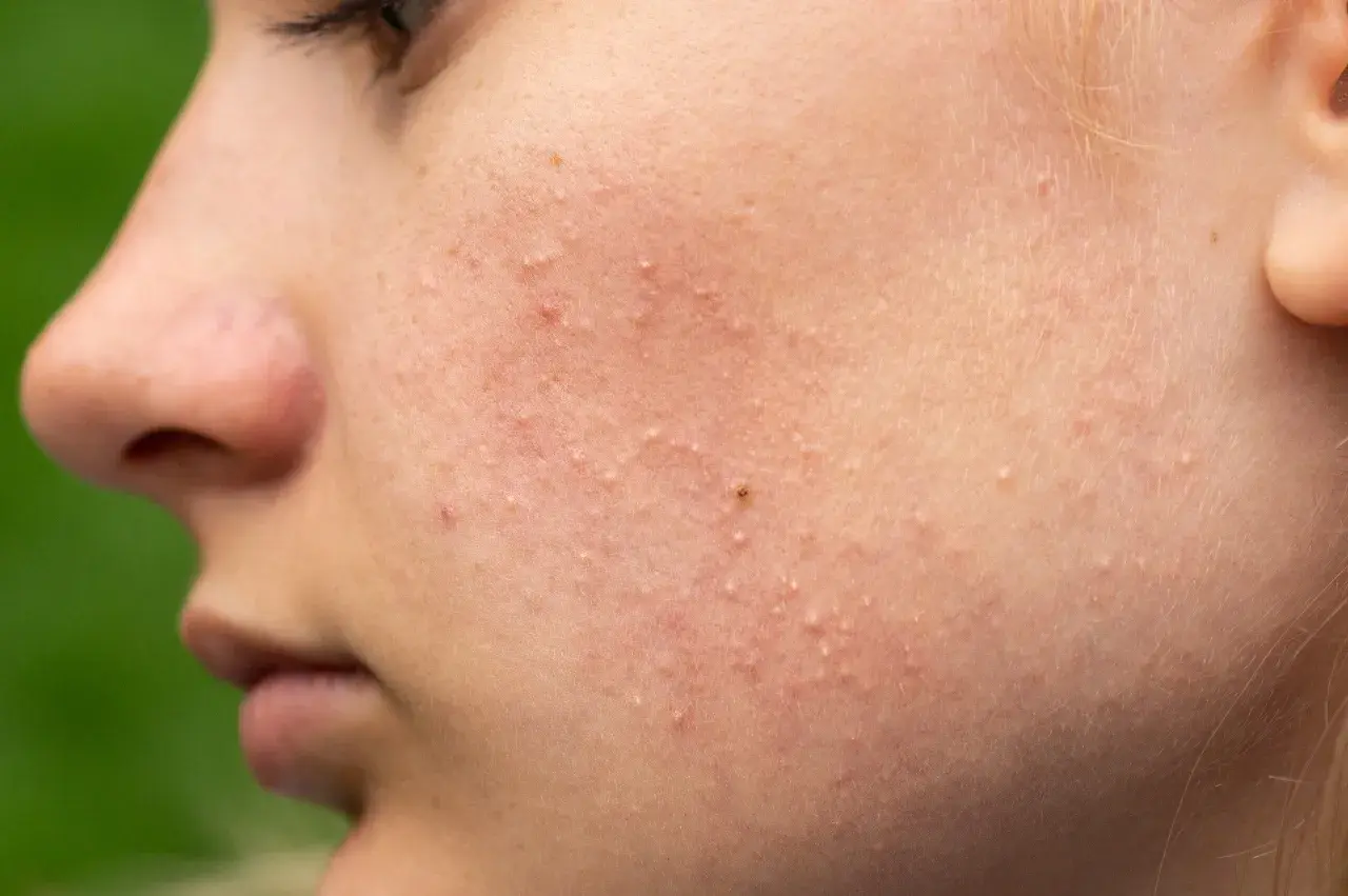 Skóra z licznymi, drobnymi białymi grudkami, które są zaskórnikami zamkniętymi.