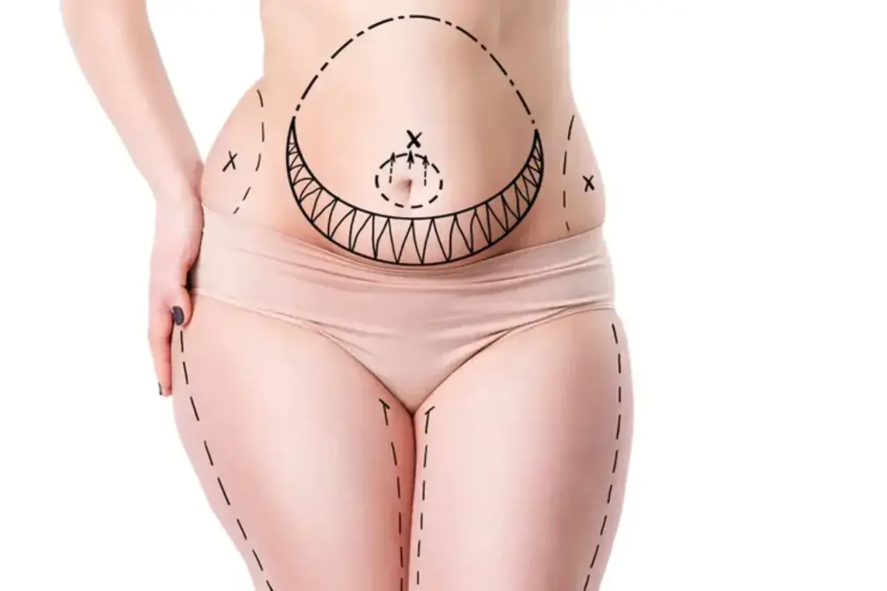 Kropp med markerade linjer för fettsugning, visar områden för vaser liposuction.