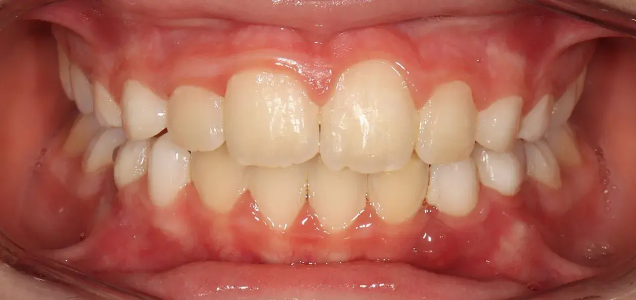 Dientes alineados y encías sanas, un vistazo al progreso de Invisalign mes a mes.