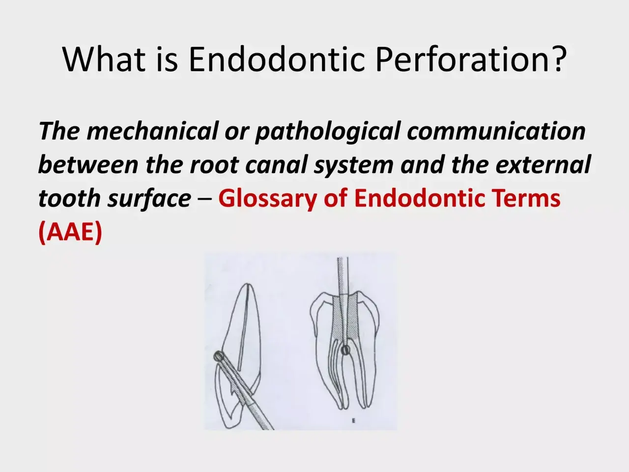 Co to jest perforacja endodontyczna? Ilustracja pokazuje komunikację między systemem kanałów korzeniowych a zewnętrzną powierzchnią zęba.