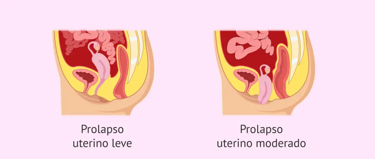 Ilustración comparativa de prolapso uterino leve y moderado, mostrando la posición del útero y órganos pélvicos.