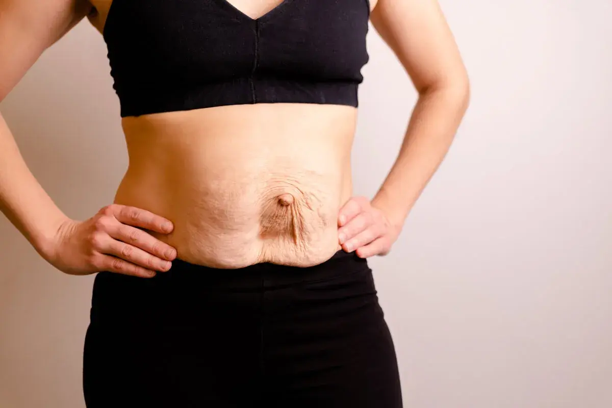 Addome con diastasi addominale di 4 cm, pelle rilassata e smagliature.