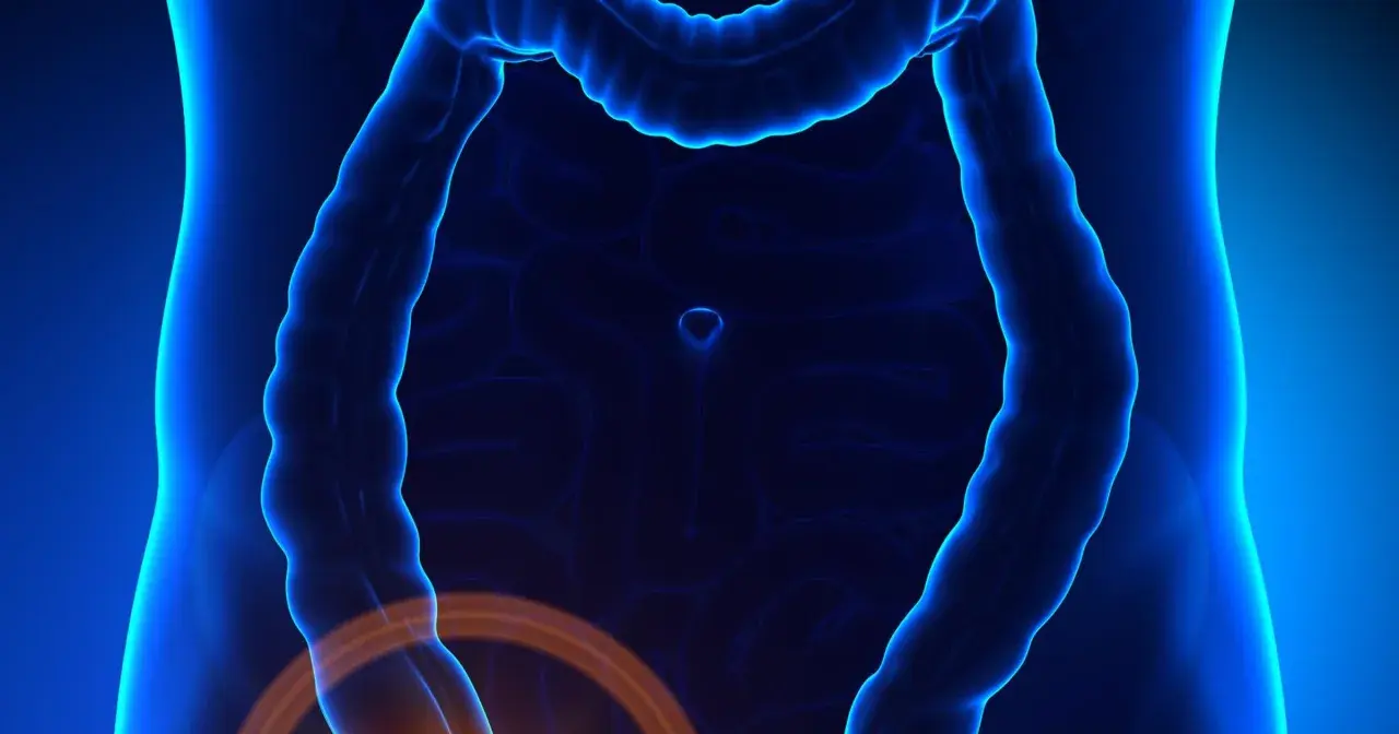 Anatomical illustration showing the intestines with a highlighted area indicating potential zapalenie wyrostka robaczkowego.
