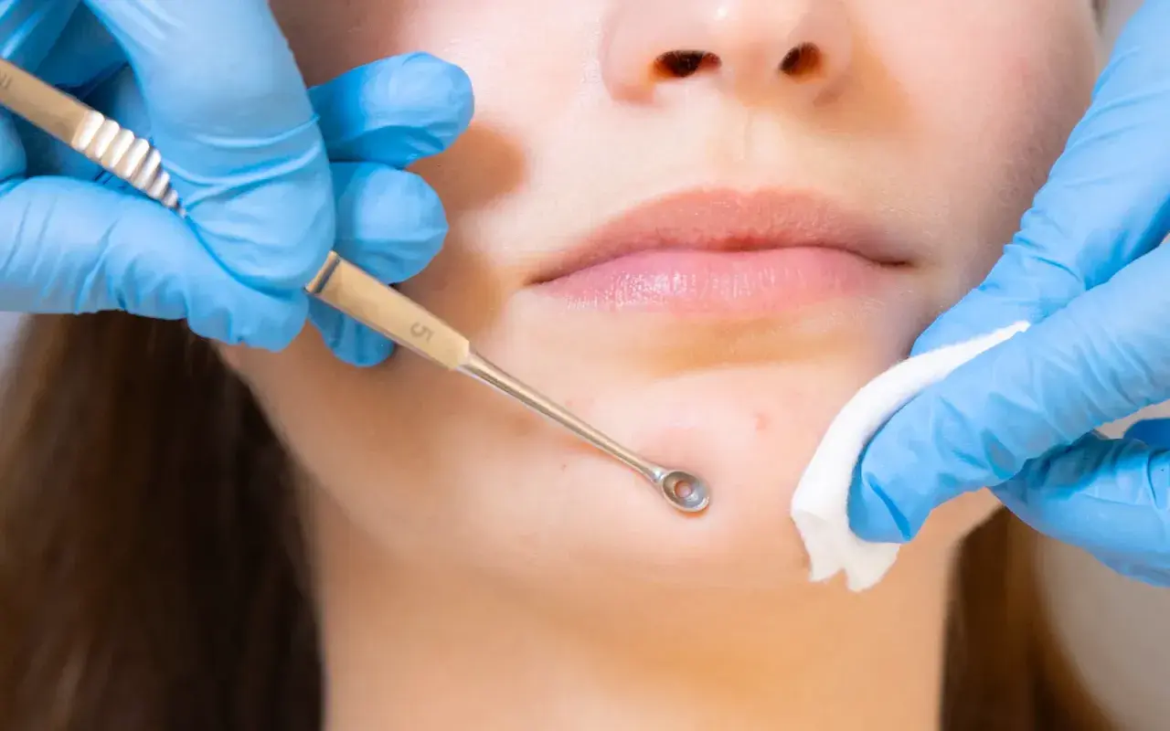 Un professionnel utilise un outil pour extraire un point noir, dans le cadre d'un soin visage en institut.