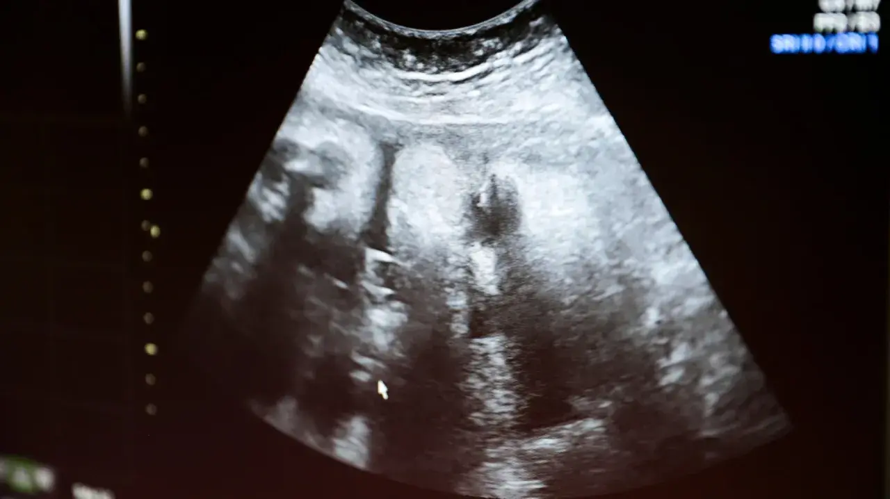Ultraljudsbild som visar tecken på missed abortion.