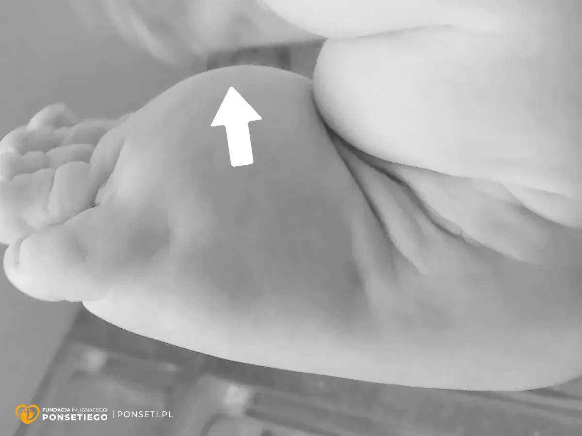 Delikatne paluszki dziecka, biała strzałka wskazuje na miękkie uczucie poduszki pod stopą.
