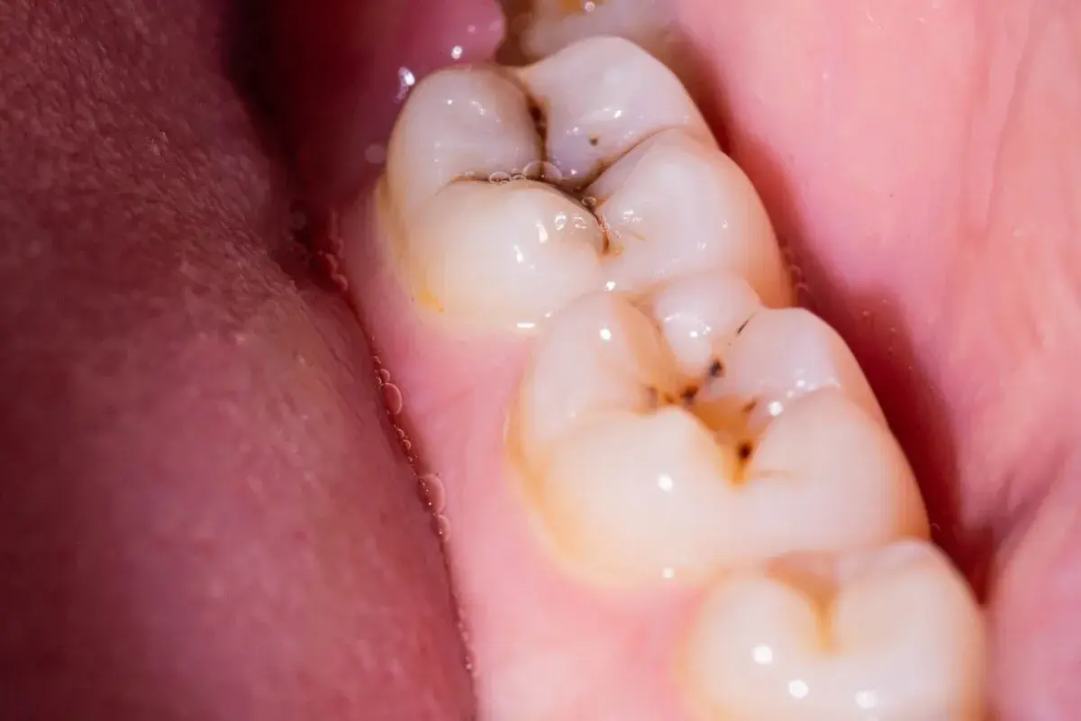 Muelas con caries y encía rosada. Para empastar una muela hace falta anestesia, ¡pero el resultado vale la pena!