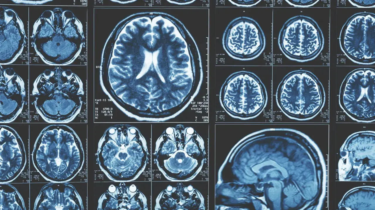 Imágenes de resonancia magnética cerebral. Cortes axiales y sagitales que muestran la estructura del cerebro, como si fuera una memoria fotogénica.