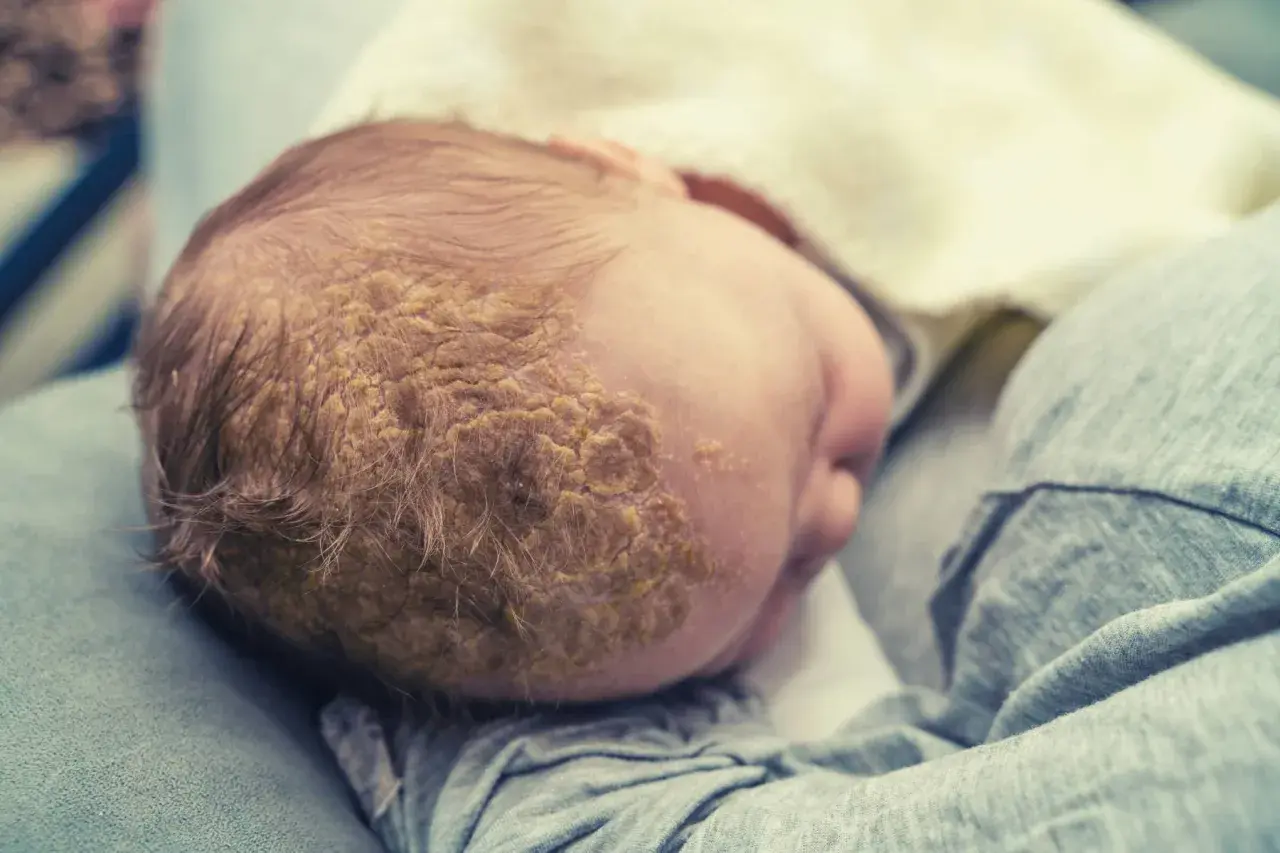 Testa di neonato con croste di dermatite seborroica, comunemente chiamata "crosta lattea".