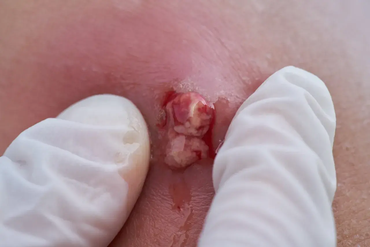 Nahaufnahme eines Abszesses in der Leiste, der von weißen Handschuhen gehalten wird. Eiter und Blut sind sichtbar.