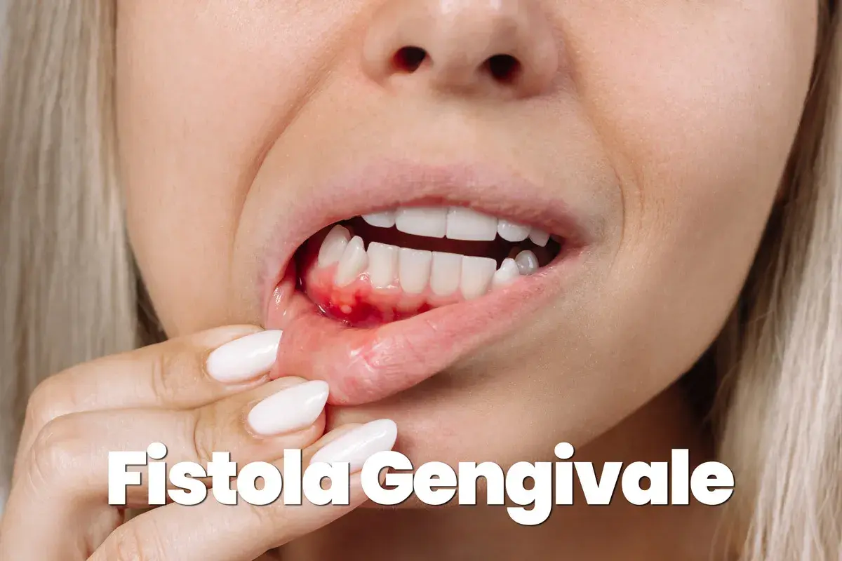 Dettaglio di una bocca con gengiva infiammata e gonfia, con piccole pustole. Potrebbe indicare una fistola gengivale, un sintomo da non sottovalutare, a volte associato a problemi più seri come un tumore.