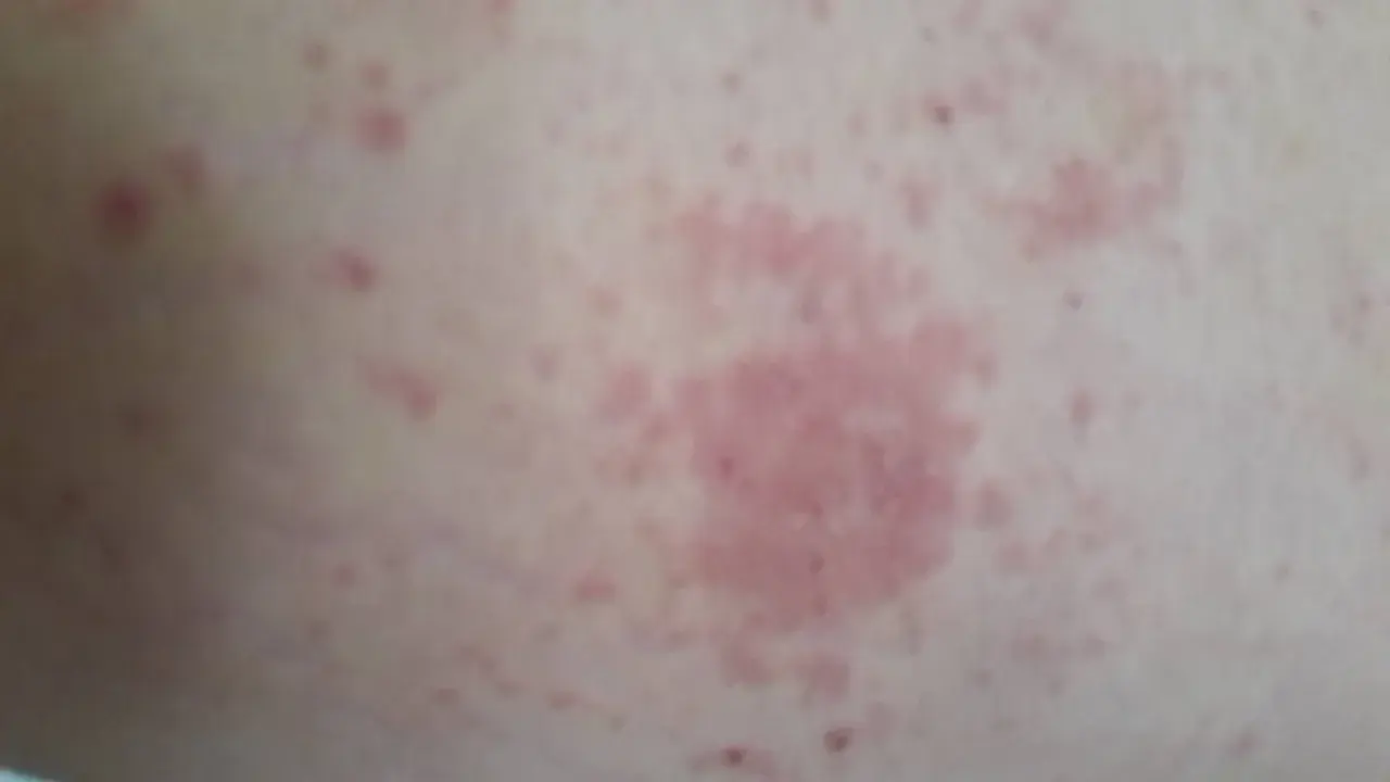 Éruption cutanée rosée sur la peau, possiblement liée à un staphylocoque doré combien de temps après opération.