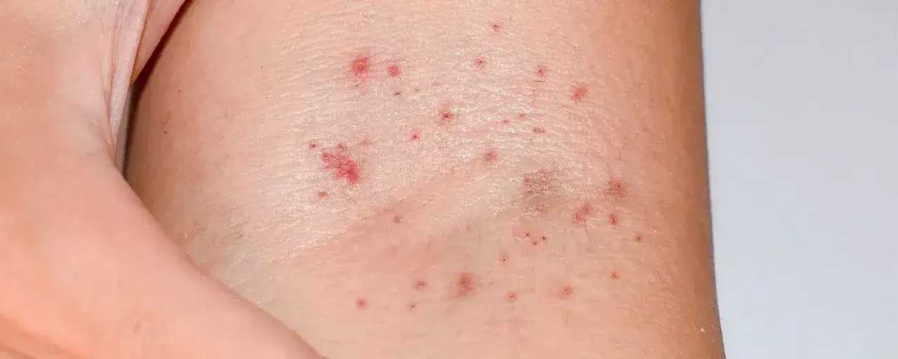 Pelle con piccole macchie rosse, che potrebbero indicare petecchie. Cosa sono? Piccoli sanguinamenti sotto la pelle.