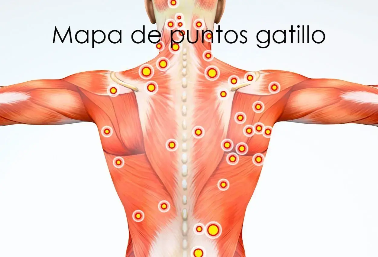 Mapa de puntos gatillo en la musculatura de la espalda y hombros.