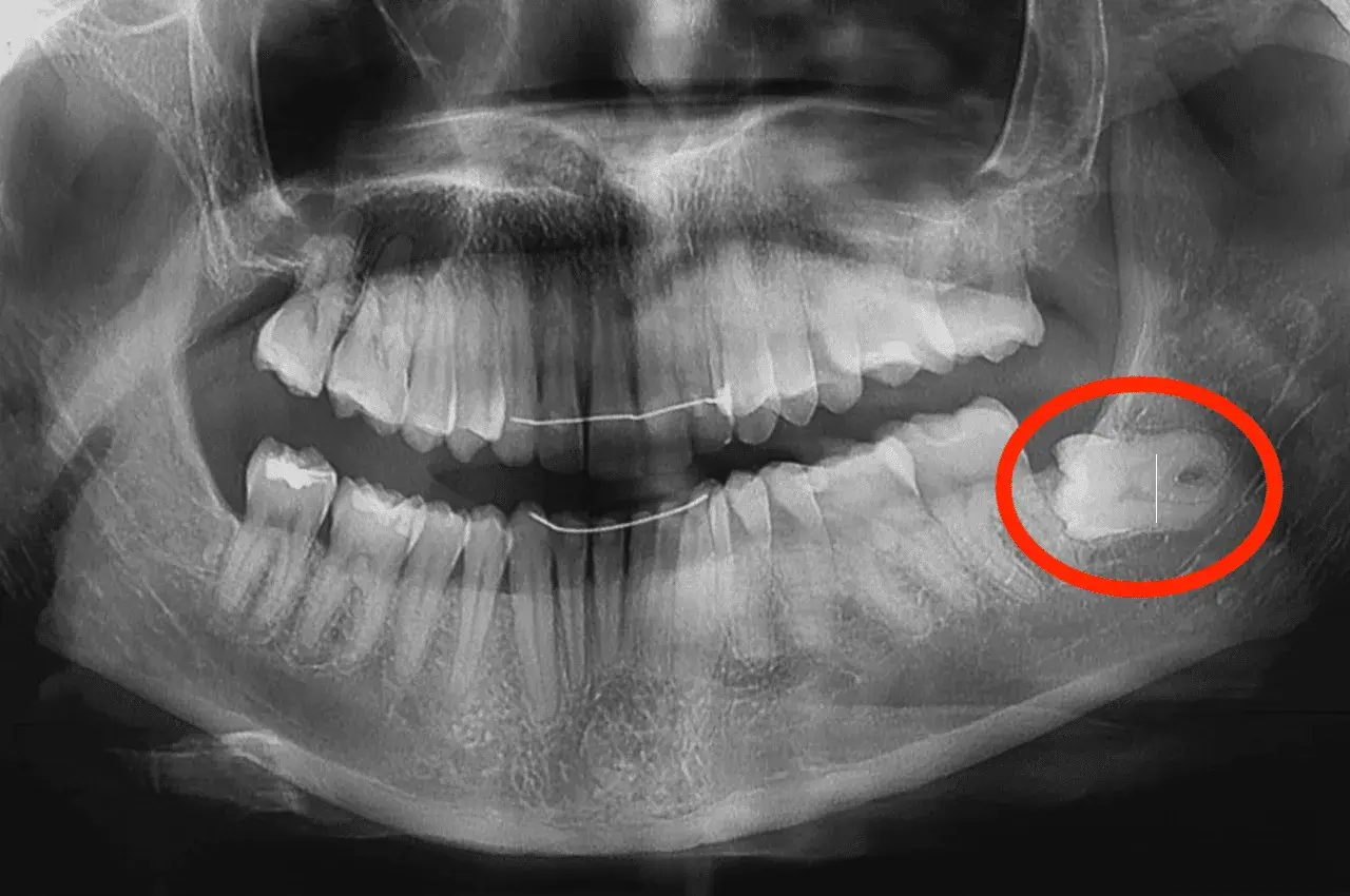 Radiografia dentale mostra un dente cariato, evidenziato in rosso. Fa male togliere una carie, ma è necessario per la salute orale.