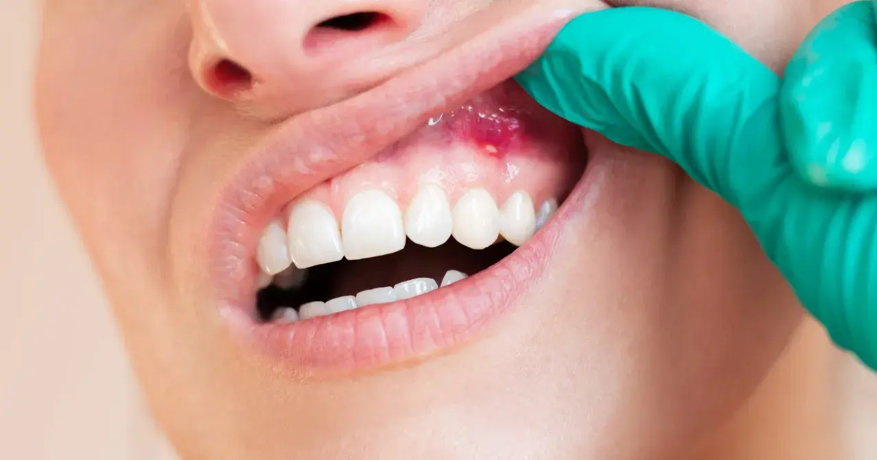 Zapalenie dziąseł, czyli problem z zakresu periodontologii. Widoczna rana na dziąśle, badana w zielonej rękawiczce.