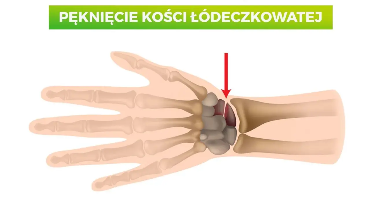 Ilustracja anatomiczna dłoni z zaznaczonym pęknięciem kości łódeczkowatej.