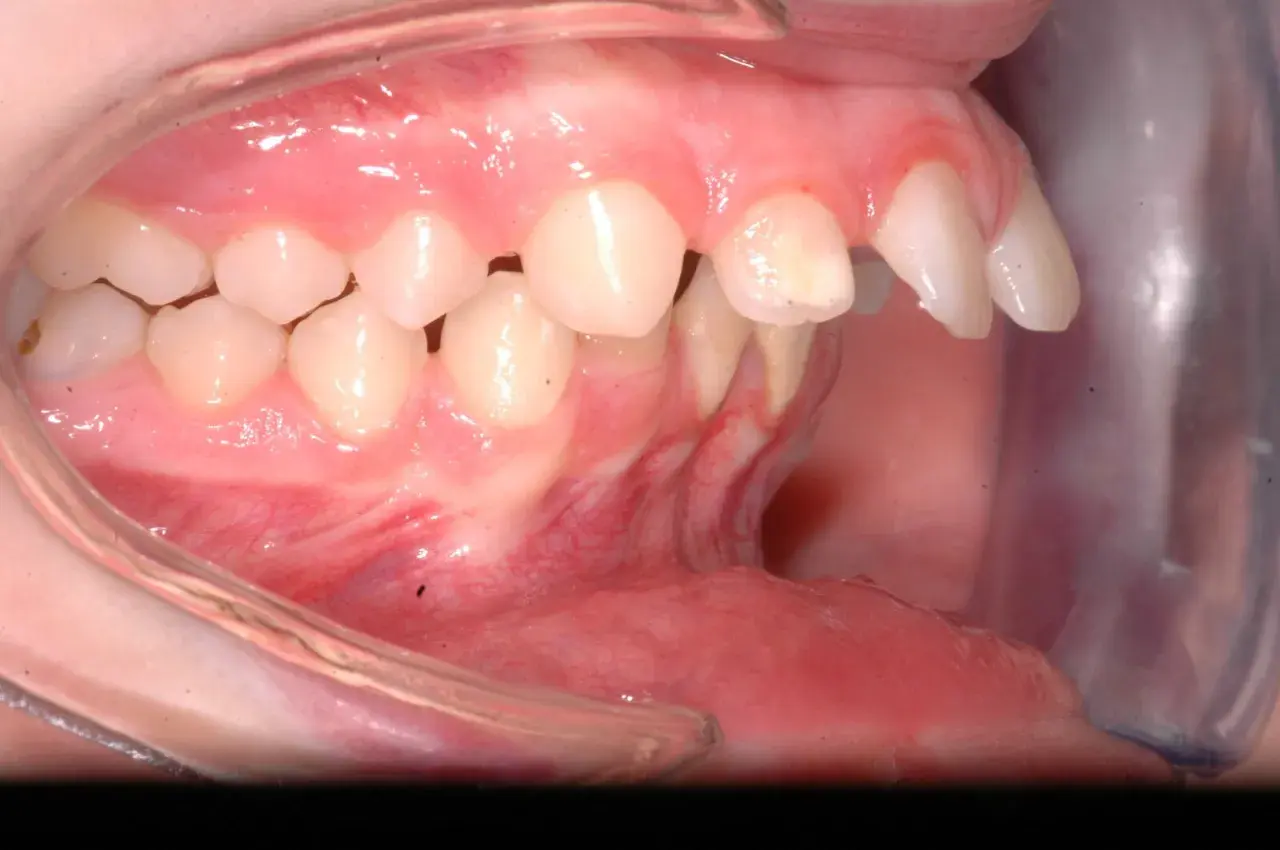 Denti superiori sporgenti e inferiori retratti, un caso di malocclusione 2 classe adulto.