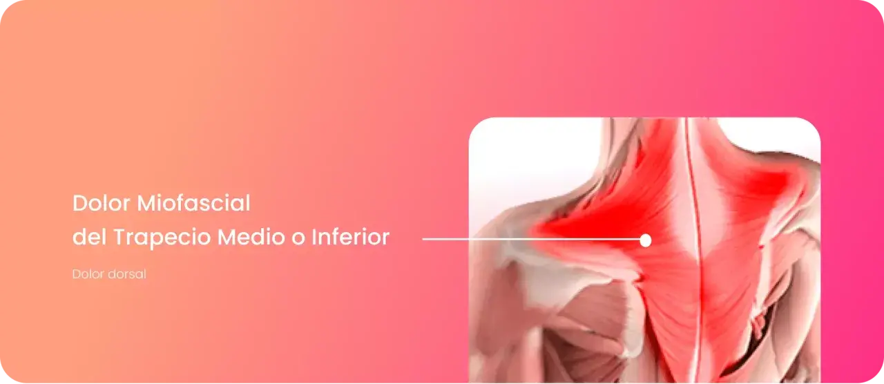 Dolor miofascial en el trapecio medio o inferior, con área inflamada en rojo.