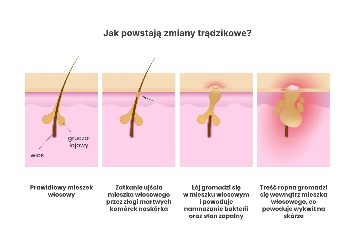 Ilustracja pokazuje, jak powstaje trądzik bakteryjny: zatkanie mieszka włosowego, namnażanie bakterii i stan zapalny prowadzący do ropnych wykwitów.