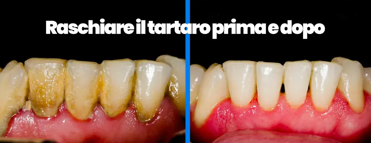 Denti con tartaro sottogengivale prima e dopo la pulizia.