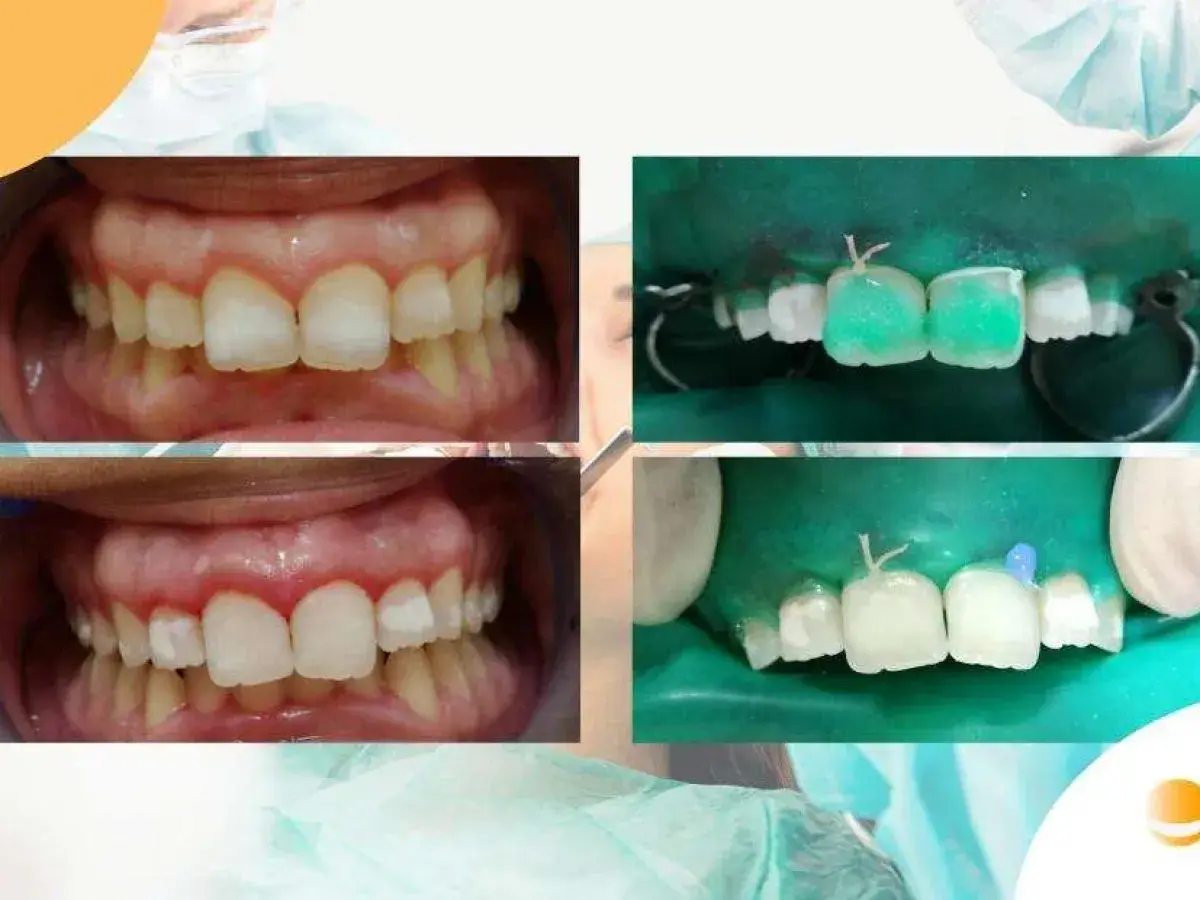 Denti con macchie bianche prima e dopo il trattamento. Si vedono i denti preparati e isolati con diga di gomma, pronti per il restauro.