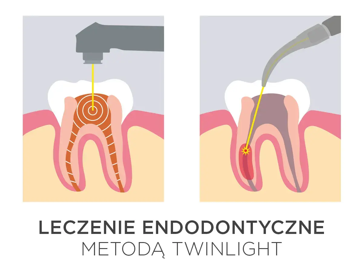 Ilustracja pokazuje laserowe leczenie zębów. Dwa etapy endodoncji z użyciem lasera, który precyzyjnie dociera do wnętrza zęba.